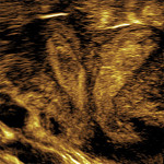 uterus-didephys